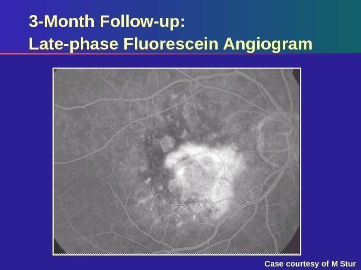 3 -Month Follow-up:  Late-phase Fluorescein Angiogram Case courtesy of M Stur 