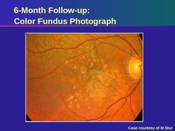 6 -Month Follow-up: Color Fundus Photograph Case courtesy of M Stur 