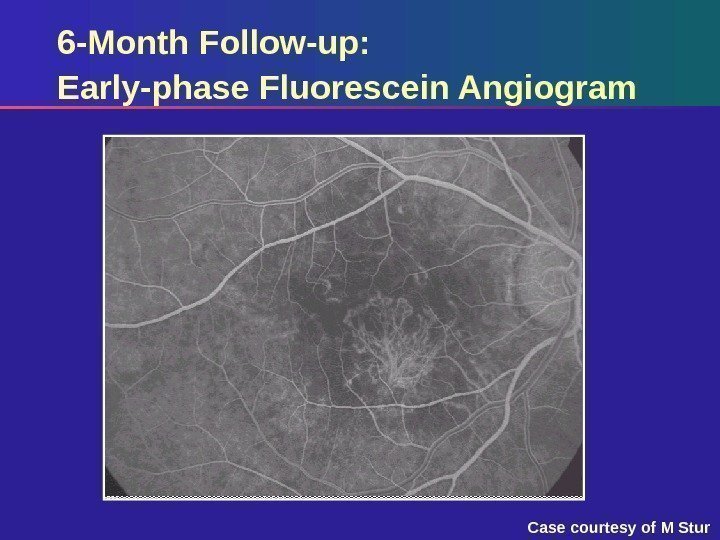 6 -Month Follow-up: Early-phase Fluorescein Angiogram Case courtesy of M Stur 