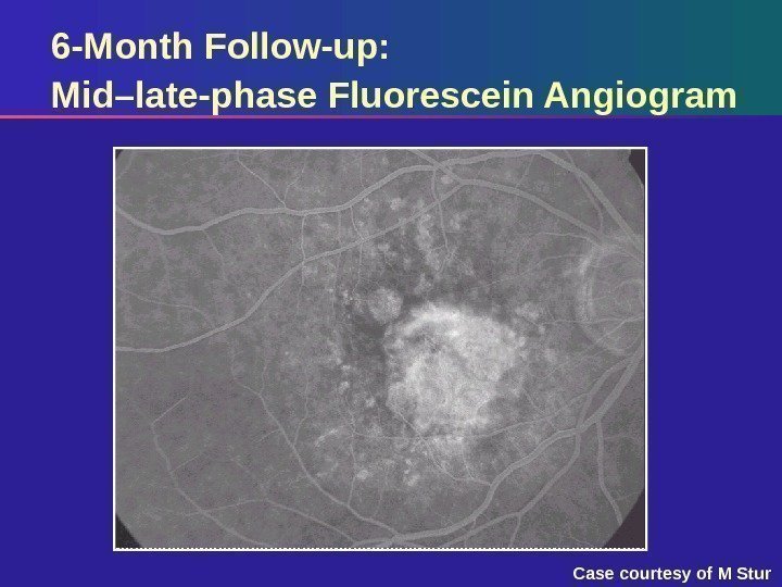 6 -Month Follow-up: Mid–late-phase Fluorescein Angiogram Case courtesy of M Stur 