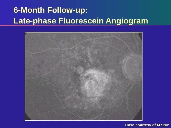 6 -Month Follow-up: Late-phase Fluorescein Angiogram Case courtesy of M Stur 