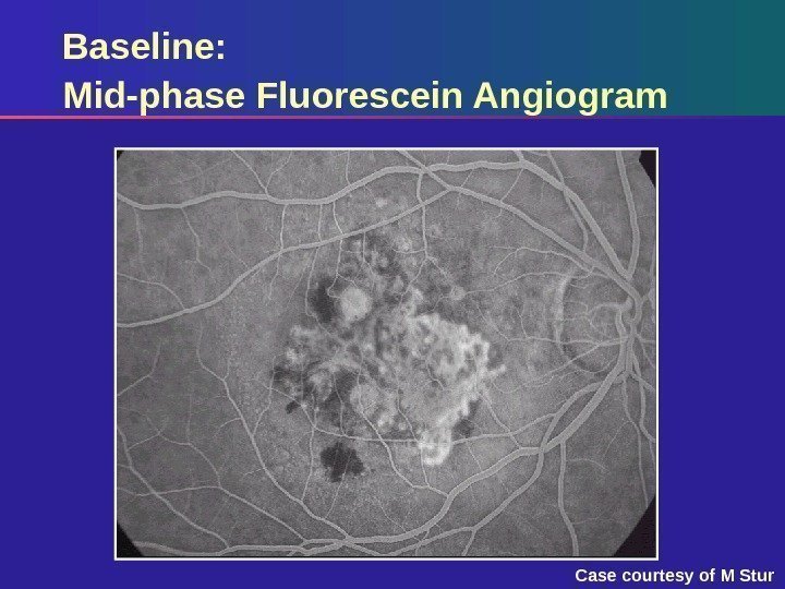 Baseline: Mid-phase Fluorescein Angiogram Case courtesy of M Stur 