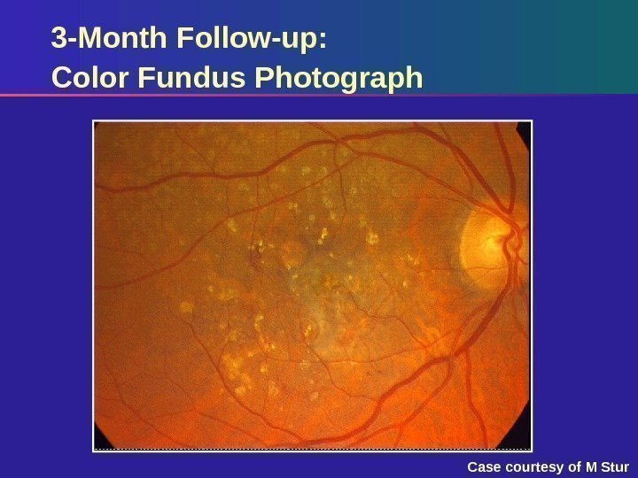 3 -Month Follow-up: Color Fundus Photograph Case courtesy of M Stur 