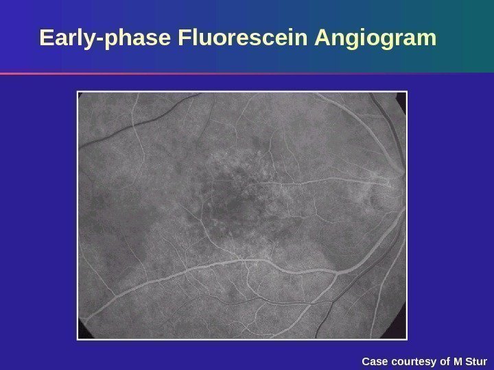 Early-phase Fluorescein Angiogram Case courtesy of M Stur 