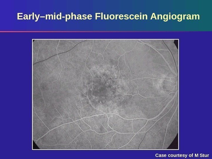 Early–mid-phase Fluorescein Angiogram Case courtesy of M Stur 