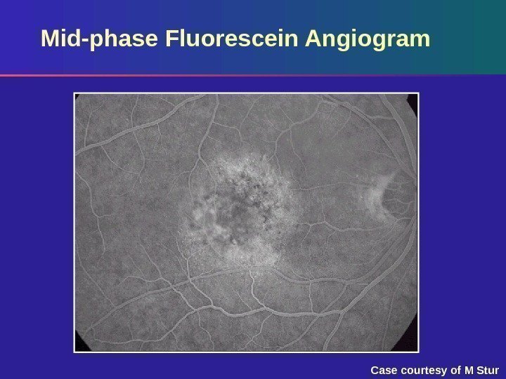 Mid-phase Fluorescein Angiogram Case courtesy of M Stur 