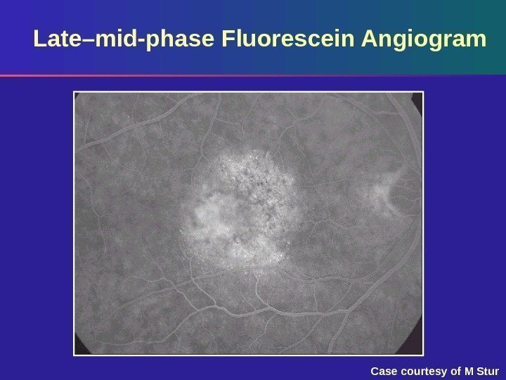 Late–mid-phase Fluorescein Angiogram Case courtesy of M Stur 