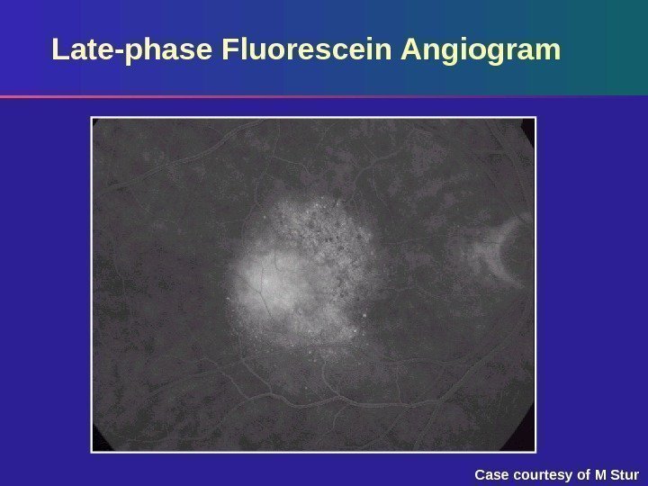 Late-phase Fluorescein Angiogram Case courtesy of M Stur 