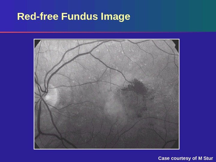 Red-free Fundus Image Case courtesy of M Stur 