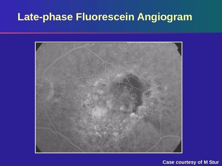 Late-phase Fluorescein Angiogram Case courtesy of M Stur 