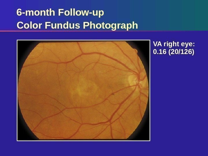 6 -month Follow-up Color Fundus Photograph VA right eye:  0. 16 (20/126) 