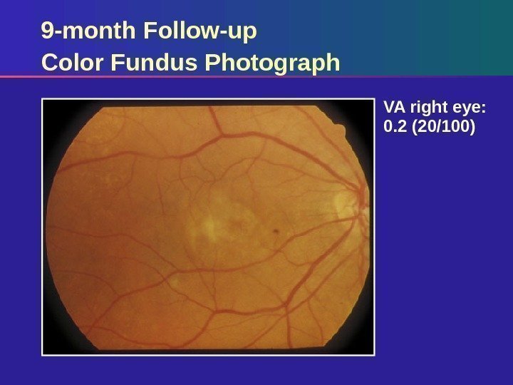 9 -month Follow-up Color Fundus Photograph VA right eye:  0. 2 (20/100) 