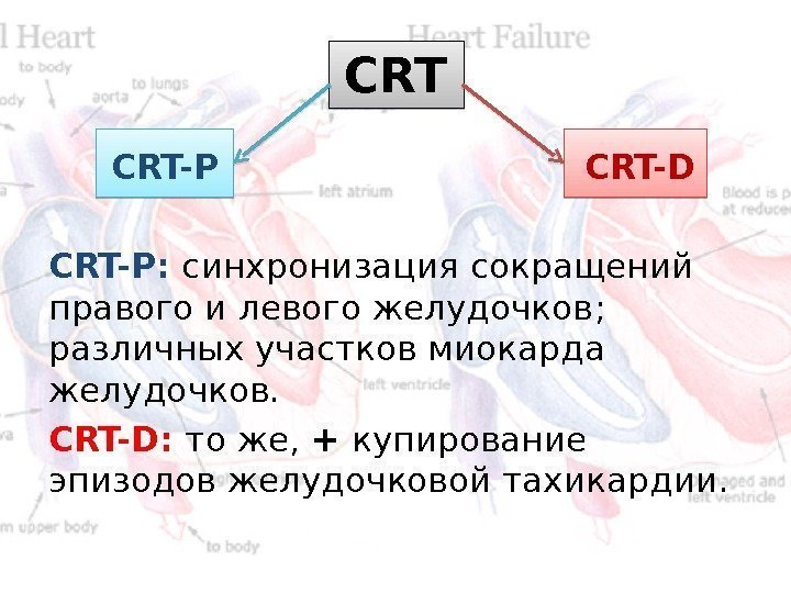 CRT   CRT-P    CRT-D CRT-P :  синхронизация сокращений правого