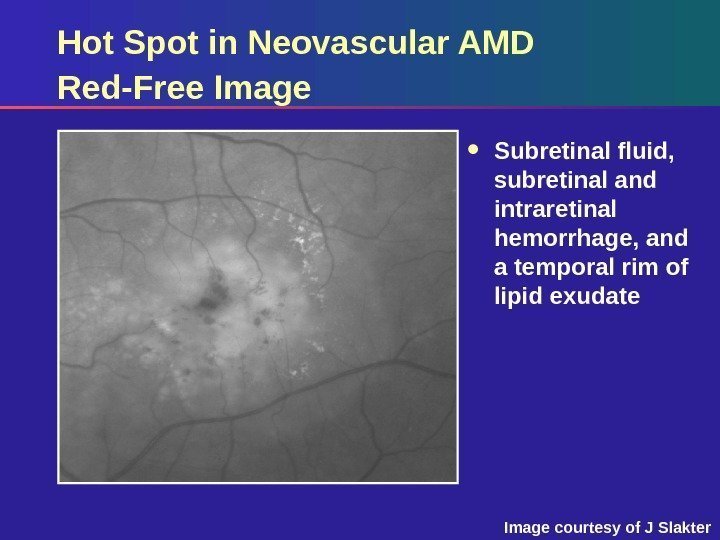 Hot Spot in Neovascular AMD Red-Free Image Subretinal fluid,  subretinal and intraretinal hemorrhage,
