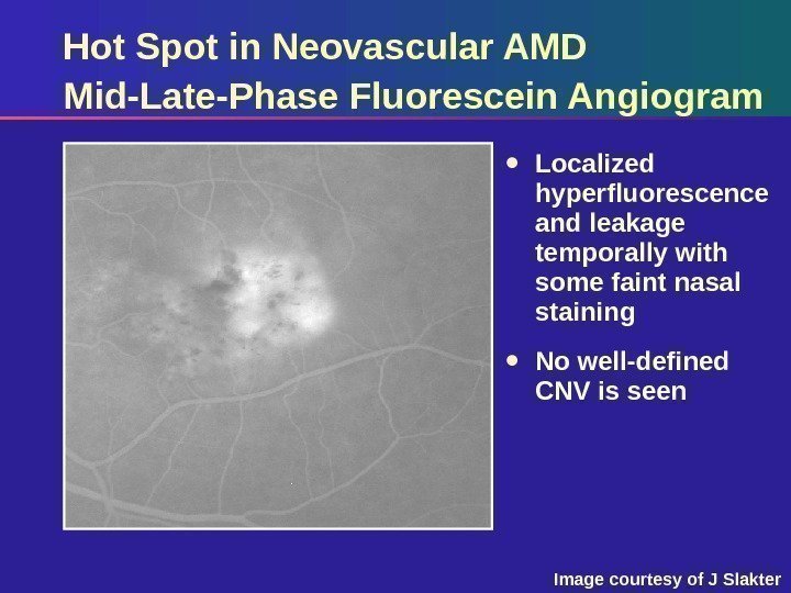 Hot Spot in Neovascular AMD Mid-Late-Phase Fluorescein Angiogram Localized hyperfluorescence and leakage temporally with