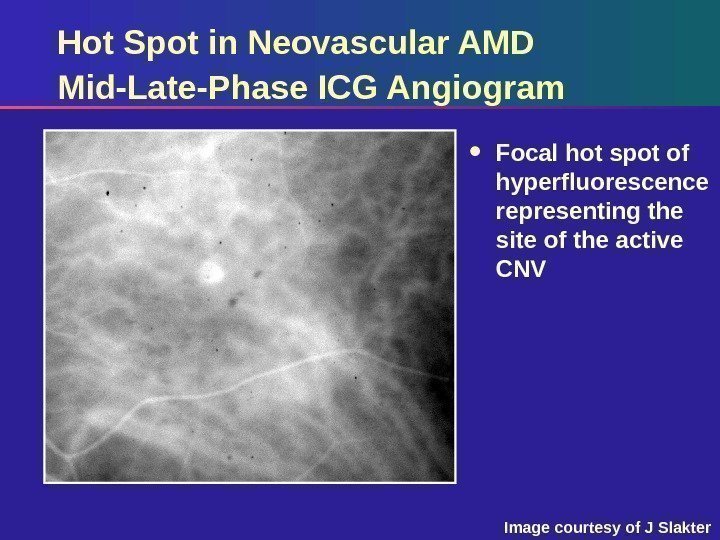 Hot Spot in Neovascular AMD Mid-Late-Phase ICG Angiogram Focal hot spot of hyperfluorescence representing