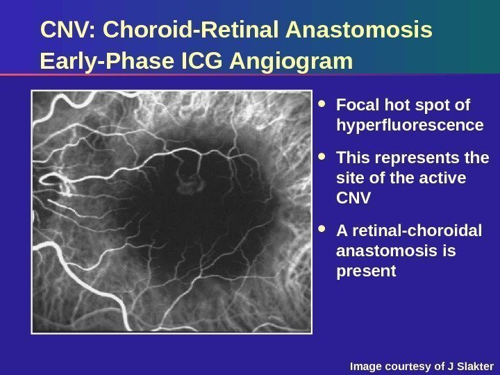 CNV: Choroid-Retinal Anastomosis Early-Phase ICG Angiogram Focal hot spot of hyperfluorescence This represents the