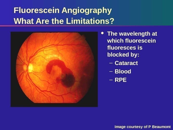 Fluorescein Angiography What Are the Limitations?  The wavelength at which fluorescein fluoresces is