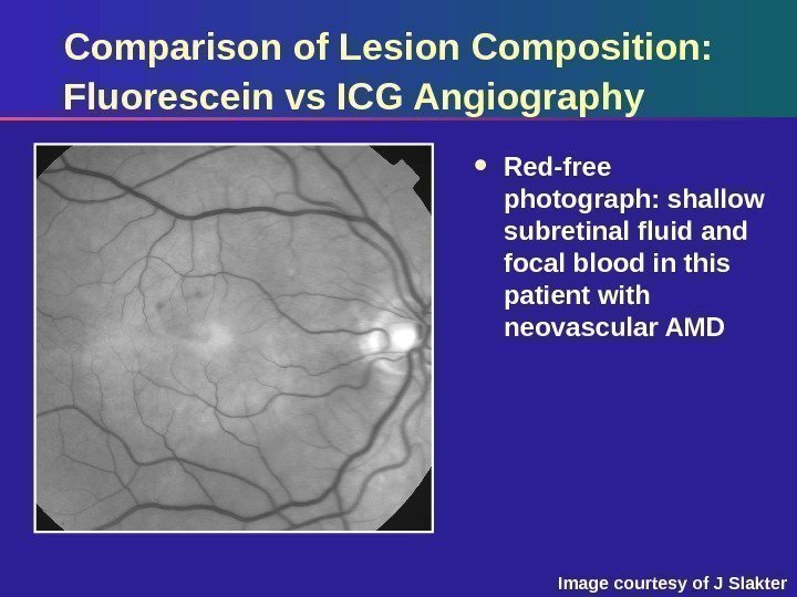 Comparison of Lesion Composition:  Fluorescein vs ICG Angiography Red-free photograph: shallow subretinal fluid