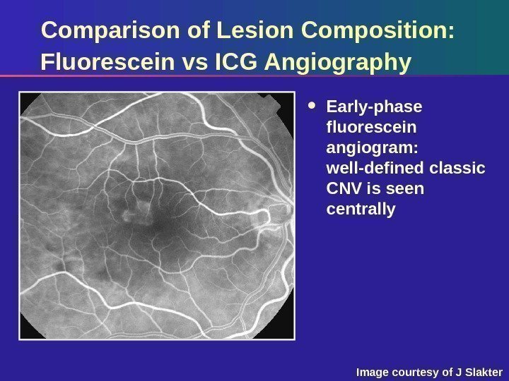 Comparison of Lesion Composition:  Fluorescein vs ICG Angiography Early-phase fluorescein angiogram:  well-defined