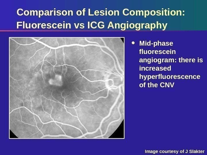 Comparison of Lesion Composition:  Fluorescein vs ICG Angiography Mid-phase fluorescein angiogram: there is