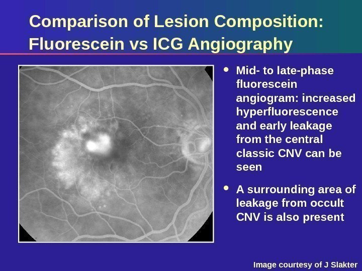 Comparison of Lesion Composition:  Fluorescein vs ICG Angiography Mid- to late-phase fluorescein angiogram: