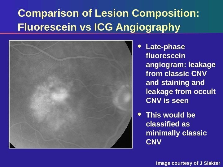 Comparison of Lesion Composition:  Fluorescein vs ICG Angiography Late-phase fluorescein angiogram: leakage from