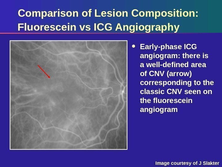 Comparison of Lesion Composition:  Fluorescein vs ICG Angiography Early-phase ICG angiogram: there is