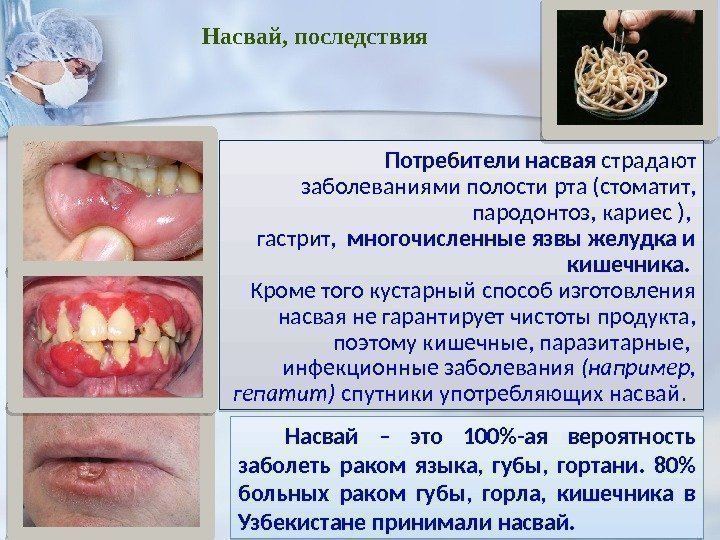  Потребители насвая страдают заболеваниями полости рта (стоматит,  пародонтоз, кариес ),  гастрит,
