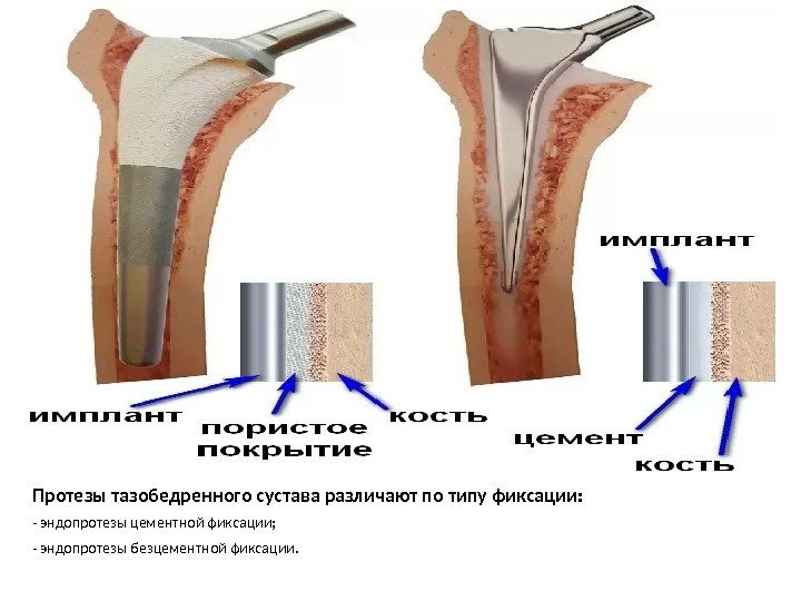 Протезы тазобедренного сустава различают по типу фиксации: - эндопротезы цементной фиксации;  - эндопротезы