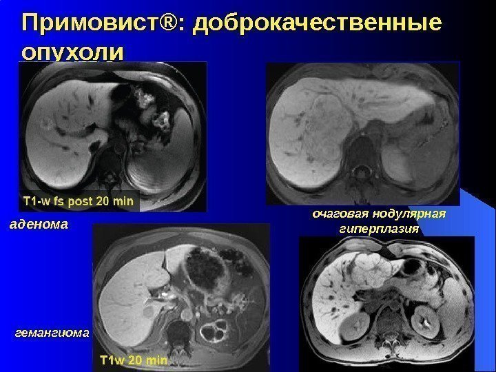 Примовист ®® : доброкачественные опухоли аденома очаговая нодулярная гиперплазия гемангиома 