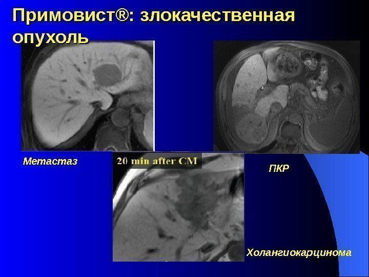 Примовист ®® : злокачественная опухоль Метастаз ПКР Холангиокарцинома 