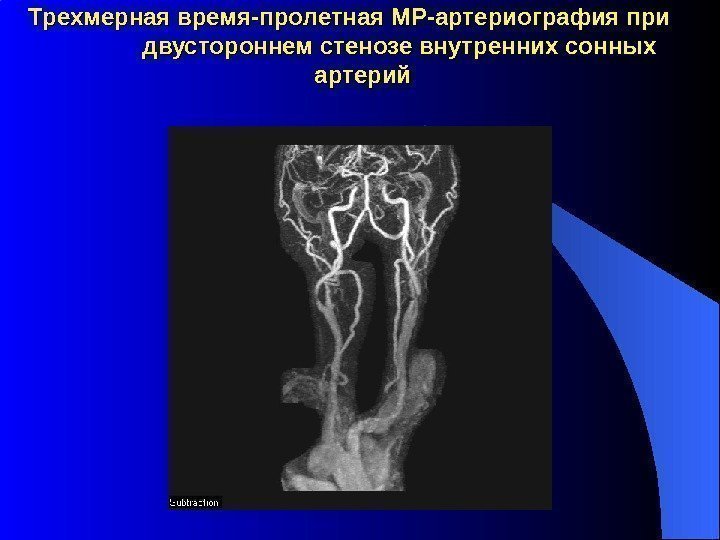 Трехмерная время-пролетная МР-артериография при   двустороннем стенозе внутренних сонных артерий 