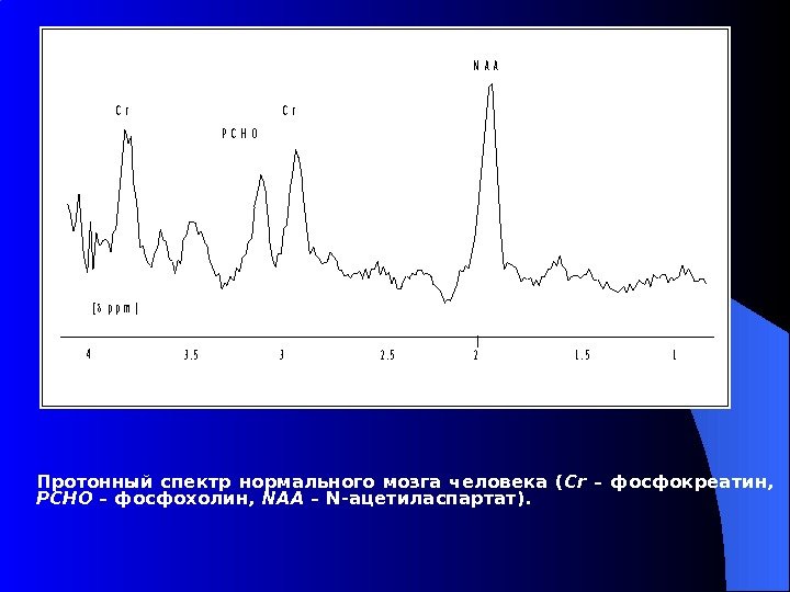 Протонный спектр нормального мозга человека ( Cr  – фосфокреатин,  РСНО – фосфохолин,