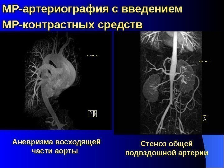 МР-артериография с введением МР-контрастных средств  Аневризма восходящей части аорты  Стеноз общей подвздошной