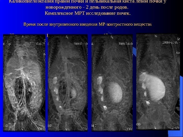 Каликопиелоэктазия правой почки и пельвикальная киста левой почки у новорожденного - 2 день после