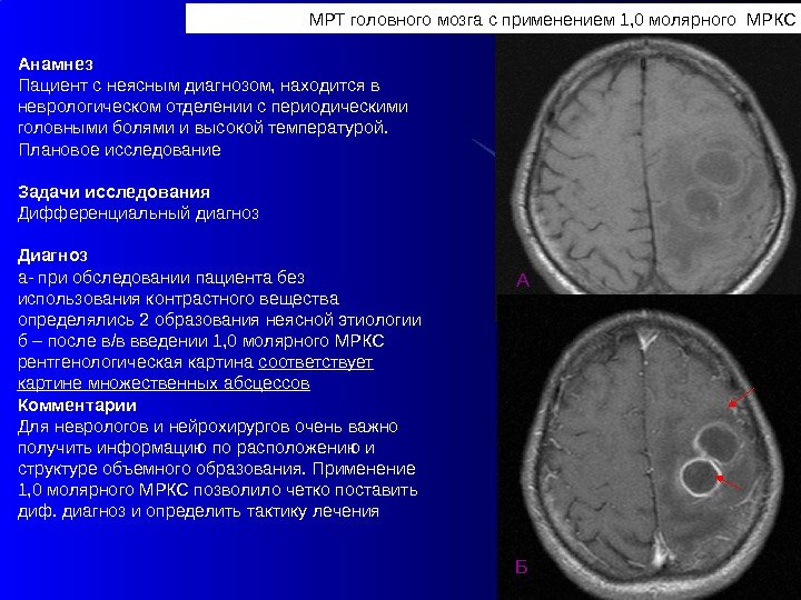 МРТ головного мозга с применением 1, 0 молярного МРКС Б ААнамнез Пациент с неясным