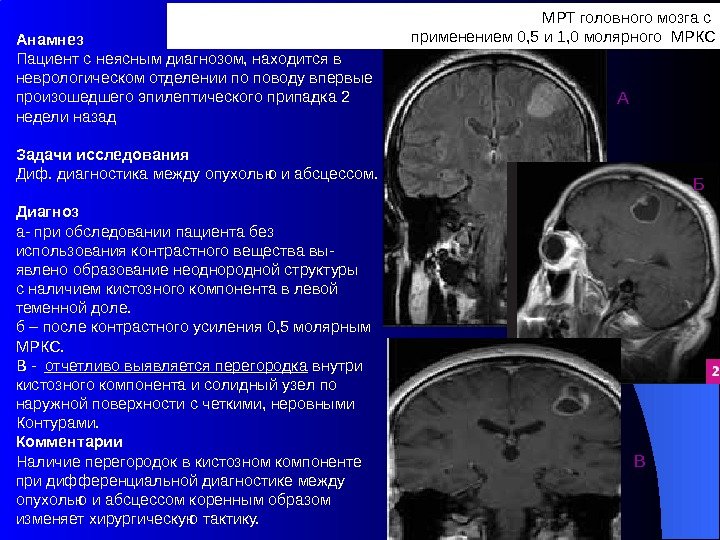 МРТ головного мозга с применением 0, 5 и 1, 0 молярного МРКС Анамнез Пациент