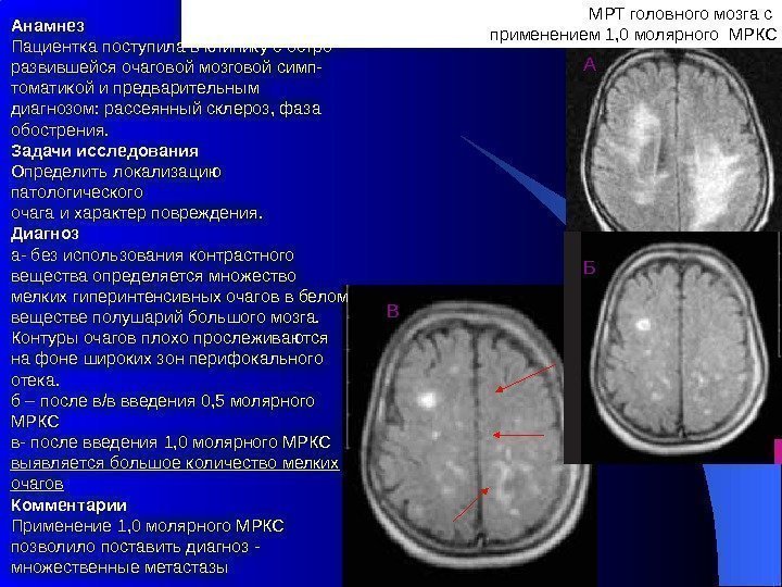 МРТ головного мозга с применением 1, 0 молярного МРКСАнамнез Пациентка поступила в клинику с