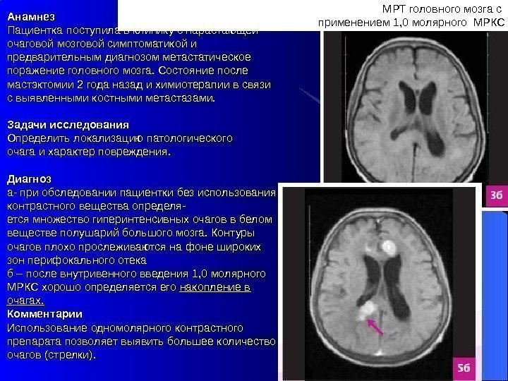 МРТ головного мозга с применением 1, 0 молярного МРКСАнамнез Пациентка поступила в клинику с