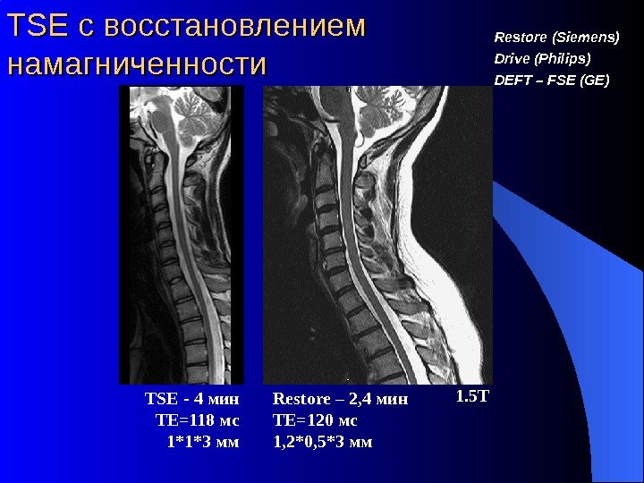 TSETSE с восстановлением намагниченности Restore (Siemens) Drive (Philips) DEFT – FSE (GE) 1. 5