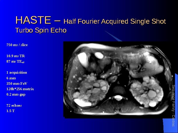 HASTE – Half Fourier Acquired Single Shot Turbo Spin Echo 750 ms / slice