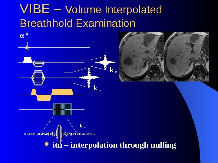 VIBE – Volume Interpolated Breathhold Examination itn – interpolation through nulling k y k