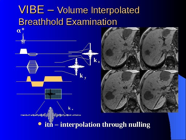 k y. VIBE – Volume Interpolated Breathhold Examination itn – interpolation through nulling °