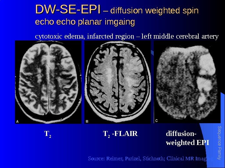 DW-SE-EPI – diffusion weighted spin echo planar imgaingecho planar imgaing c ytotoxic edema, infarcted