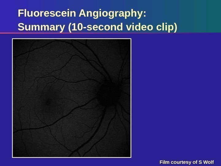 Fluorescein Angiography:  Summary (10 -second video clip) Film courtesy of S Wolf 
