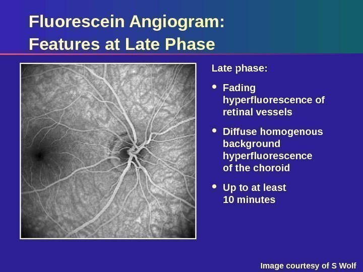Fluorescein Angiogram:  Features at Late Phase Late phase:  Fading hyperfluorescence of retinal