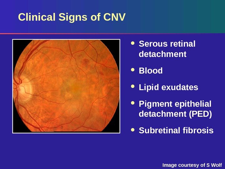 Image courtesy of S Wolf. Clinical Signs of CNV Serous retinal detachment Blood 