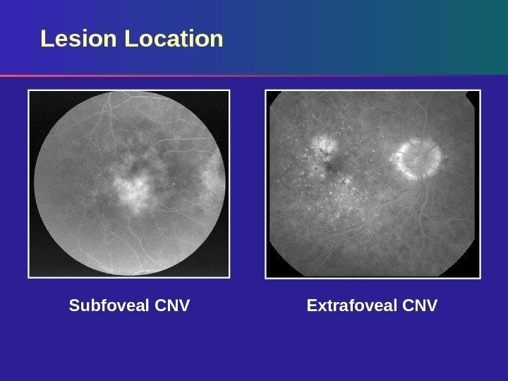 Lesion Location Extrafoveal CNVSubfoveal CNV 