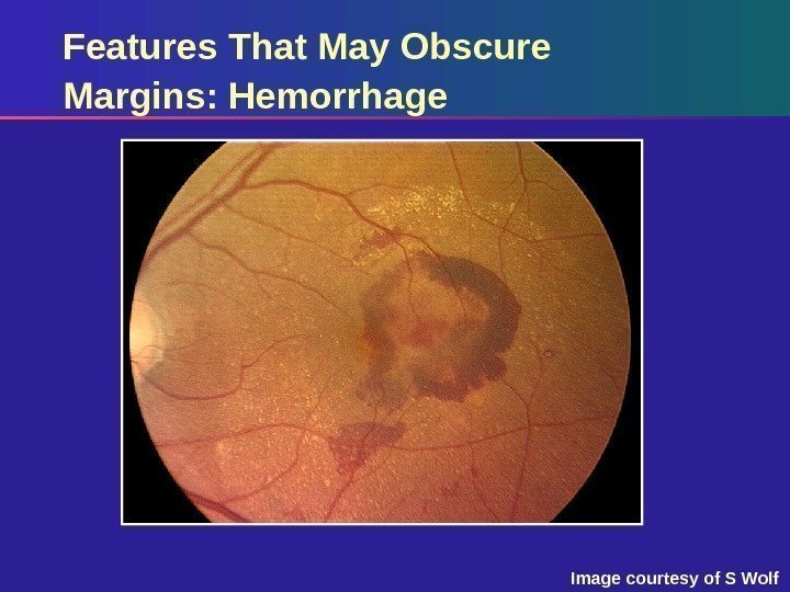 Features That May Obscure Margins: Hemorrhage Image courtesy of S Wolf 